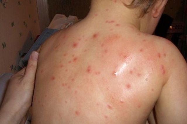 Measles epidemic declared in Skopje