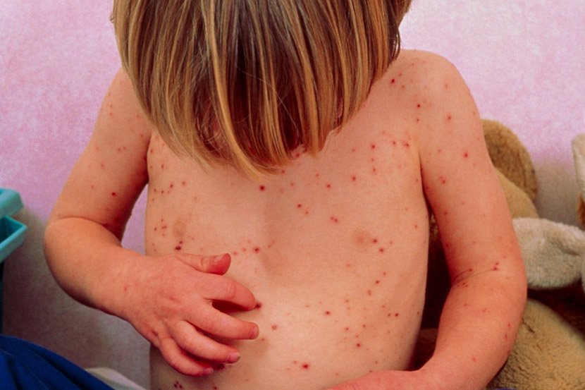 105 new measles cases, 27,000 people vaccinated so far