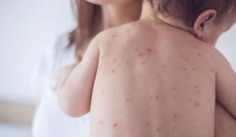 An 11 months old baby dies of measles