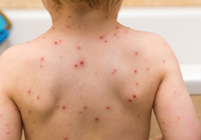 Ten new measles cases reported in Stip