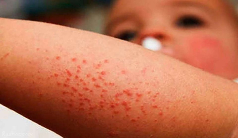 Coxsackievirus spreads among the children in a Sveti Nikole kindergarten