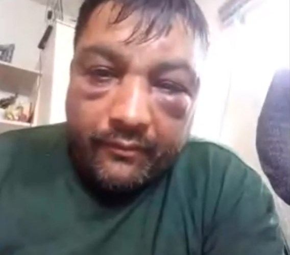 Roma man brutally beaten in Strumica says that the attackers were from Zoran Zaev’s security detail